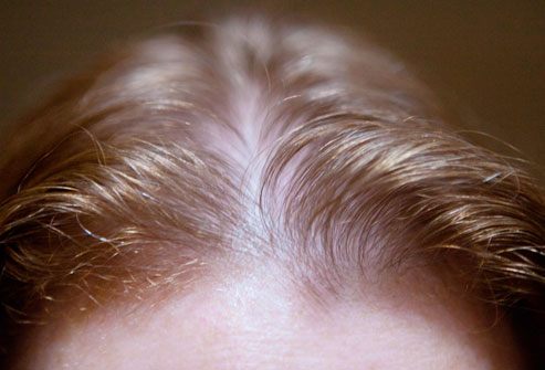 webmd_rf_photo_of_thinning_hairline_woman